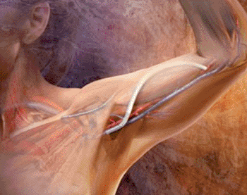 Image: The Gore Hybrid Vascular Graft sutureless anastomosis (Photo courtesy of Gore Medical Products).